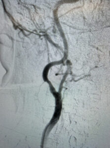 Καρωτιδική νόσος​