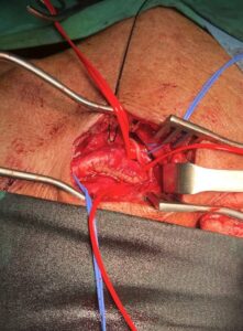 Καρωτιδική νόσος​