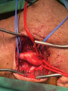 Καρωτιδική νόσος​