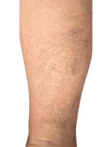 Ευρυαγγείες​