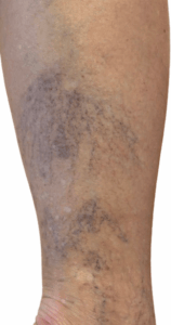 Ευρυαγγείες​