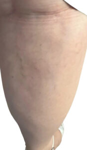 Ευρυαγγείες​