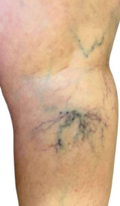 Ευρυαγγείες​