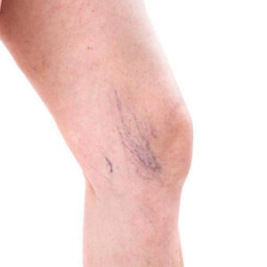 Ευρυαγγείες