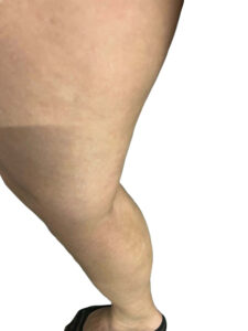 Κιρσοί κάτω άκρων​