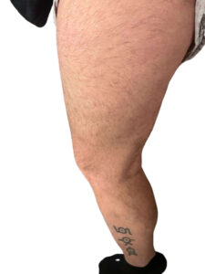 Κιρσοί κάτω άκρων​