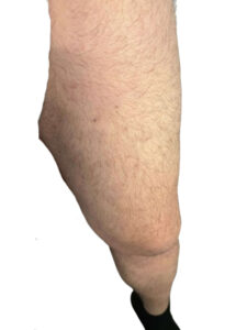 Κιρσοί κάτω άκρων​