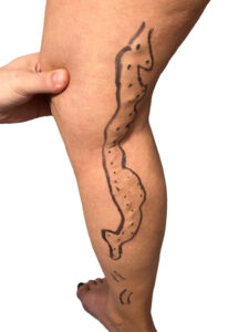 Κιρσοί κάτω άκρων​