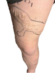 Κιρσοί κάτω άκρων​