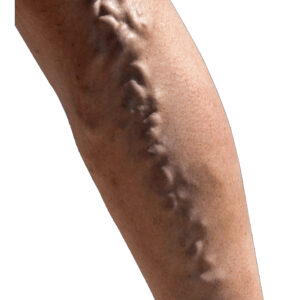 Κιρσοί κάτω άκρων​