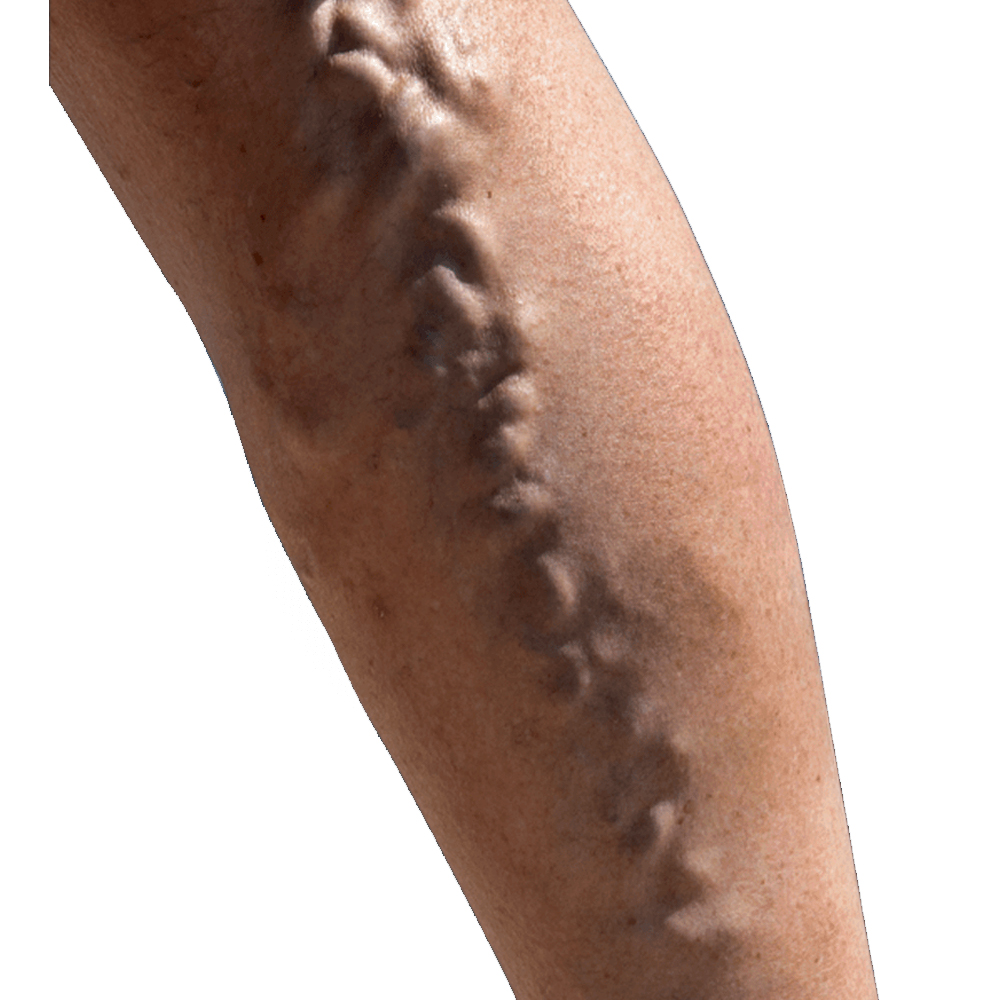 Κιρσοί κάτω άκρων​