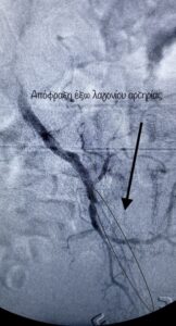 Αορτολαγόνια αποφρακτική νόσος