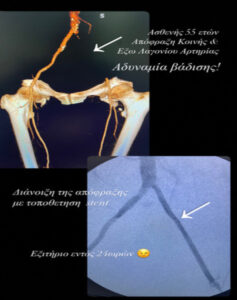 Αορτολαγόνια αποφρακτική νόσος