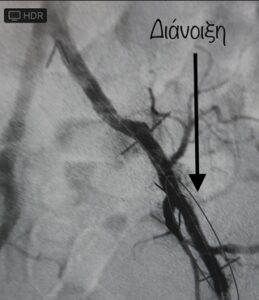 Αορτολαγόνια αποφρακτική νόσος
