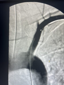 Σύνδρομο υποκλοπής υποκλειδίου αρτηρίας