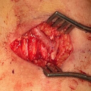 αρτηριοφλεβική επικοινωνία - fistula