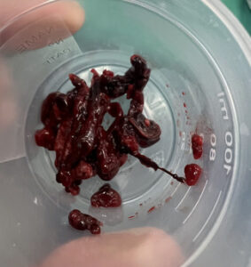 εμβολεκτομή - εμβολή