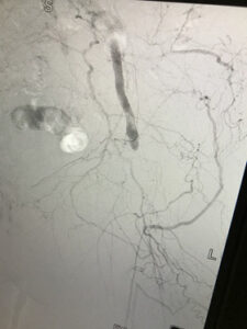 Περιφερική αρτηριοπάθεια