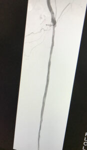 Περιφερική αρτηριοπάθεια