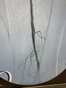 Περιφερική αρτηριοπάθεια