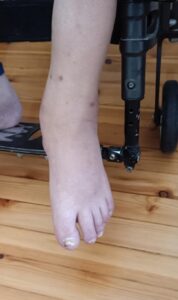 Περιφερική αρτηριοπάθεια