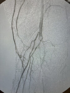 Περιφερική αρτηριοπάθεια