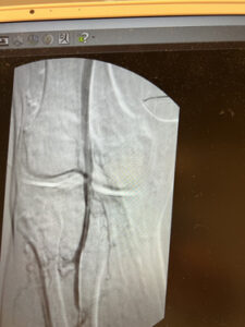 Περιφερική αρτηριοπάθεια