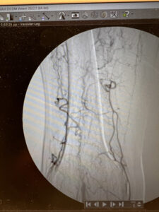 Περιφερική αρτηριοπάθεια