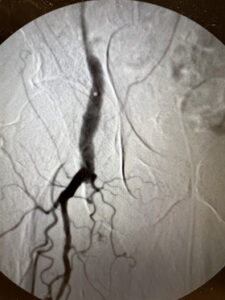 Περιφερική αρτηριοπάθεια