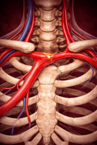 Σύνδρομο υποκλοπής υποκλειδίου αρτηρίας 