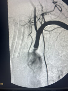 Σύνδρομο υποκλοπής υποκλειδίου αρτηρίας