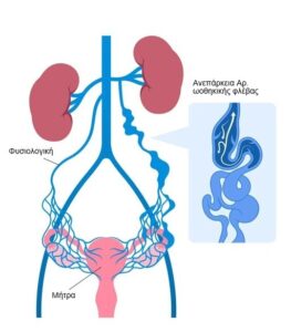 Σύνδρομο πυελικής συμφόρησης